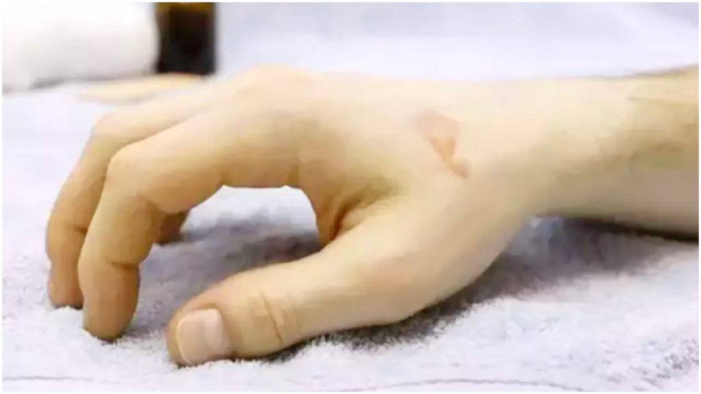 মেয়ের হানিমুন নিয়ে কথা কাটাকাটি, জামাইকে অ্যাসিড নিক্ষেপ শ্বশুরের